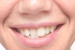 Straighten Crooked Teeth treatment in Williamsport VA