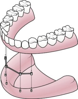implant dentures williamsport