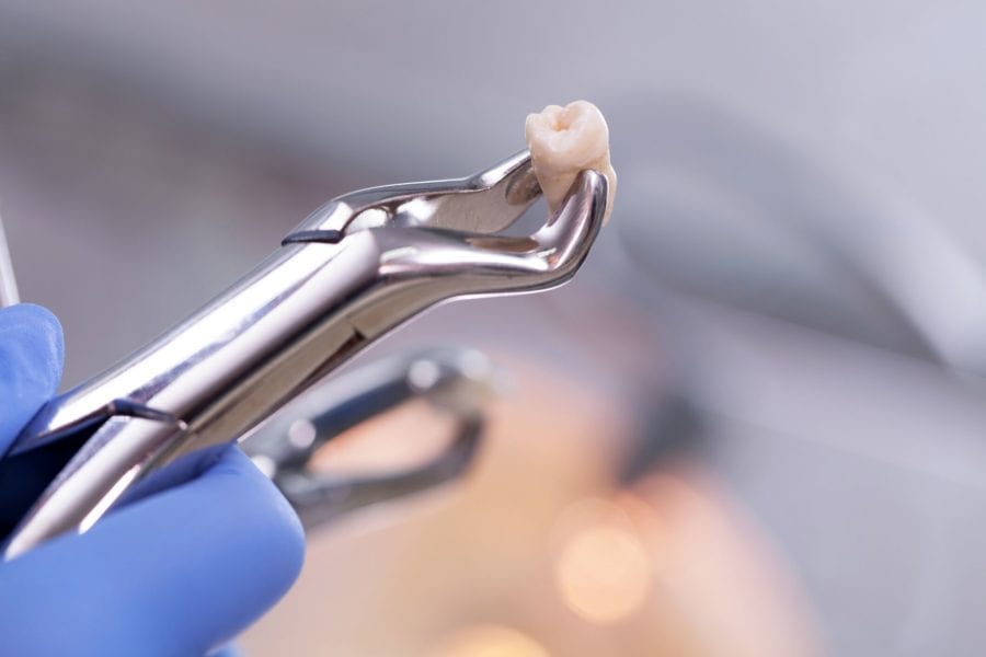 Why Do I Need a Tooth Extraction? | Williamsport PA Dentist