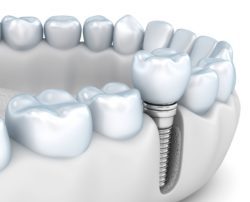 protect jawbone with implant dentistry