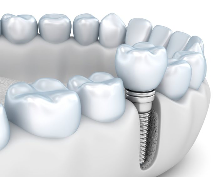implant-supported crown in Williamsport, PA