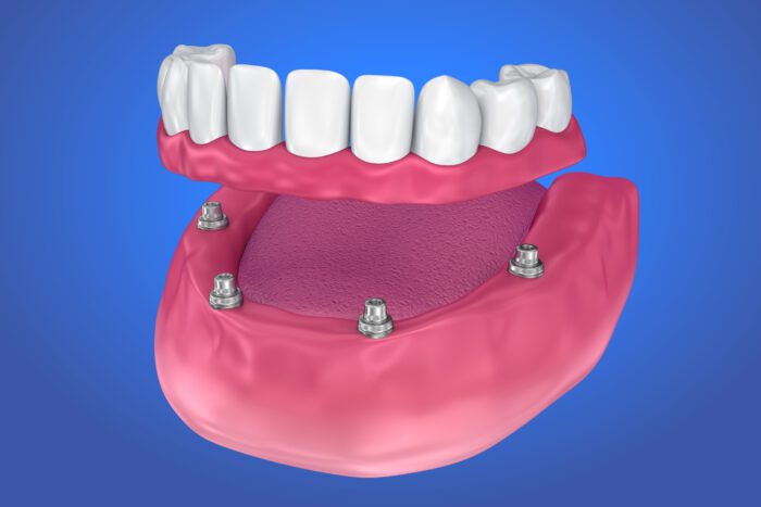 dental implants vs dentures Williamsport, PA