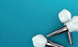 Compare Your Dental Implant Options