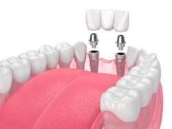 Know the Parts of a Dental Implant