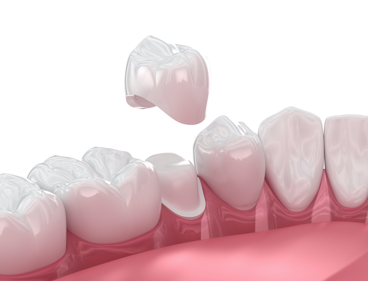 Understanding when and why you might need a dental crown can help you make informed decisions about your oral health.