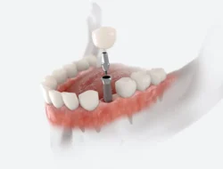 Transforming Smiles with Dental Implants in Williamsport, PA